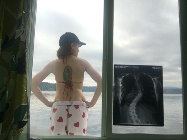 Scoliosis2017